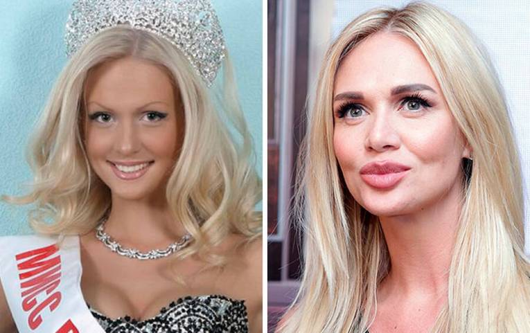 Российские звезды, которые решились на пластику, 30 фото